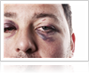 Sports Eye Injuries treatment in Chicago